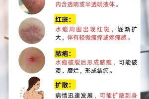 「四川新增省内感染者1312例」〃四川新增感染者的症状